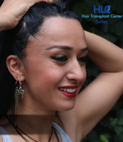 Haartransplantation Frauen