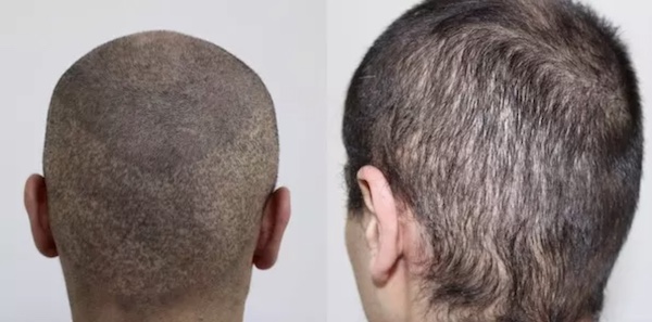Haartransplantation Türkei Istanbul exemplarisches Beispiel schlechte Haar-OP Hairforlife.info