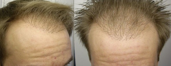 Typische negative Erfahrungen misslungene Operation: Unschöne Haarlinie mit unzufriedener Dichte - Hairforlife.info