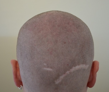 Misslungene Haartransplantation negative Erfahrung breite Narbe Hinterkopf FUT Technik - Bild Hairforlife.info