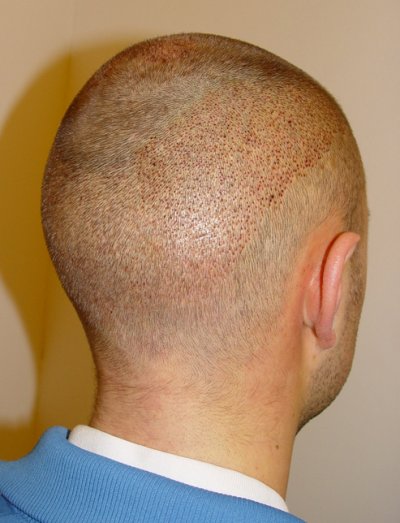 Direkt nach der Haartransplantation mit der FUE Technik: Alle Haare wurden rasiert