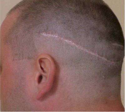 Die linienförmige FUT Haartransplantation Narbe kommt bei einer voll rasierten Glatze zum Vorschein