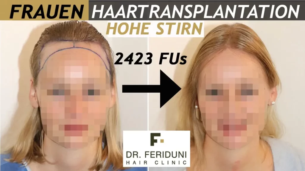 Eine hohe Stirn behandeln: Haartransplantation Vorher Nachher Resultat bei Frauen mit der FUE Technik und 2423 Fus (5032 verpflanzten Haare)