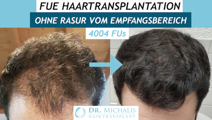 Haartransplantation Verdichtung: Beispiel einer Transplantation in bestehende Haare ohne diese dauerhaft zu beschädigen 