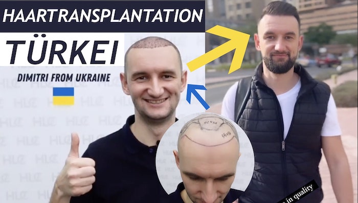 Haartransplantation Beispiel bei Männern und Vorher Nachher: Resultat der HLC Klinik
