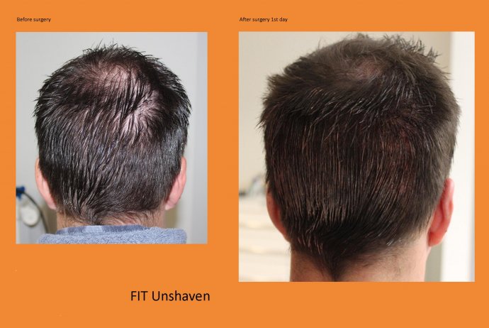 Haartransplantation ohne Rasur Unshaven Methode Entnahmebereich-Beispiel Hairforlife.info