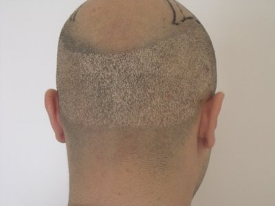 Nicht fachkundig durchgeführte FUE Haartransplantation mit unschönen Narben und Spuren am Hinterkopf