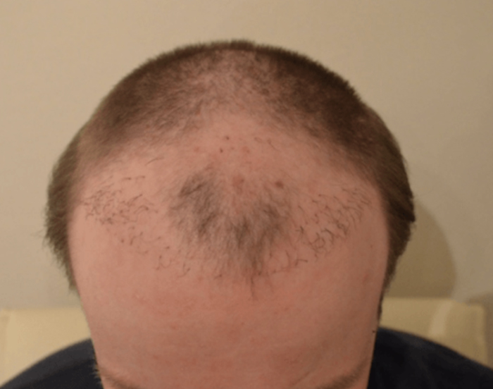 Unschöner Fall einer misslungenen und verpfuschten Haartransplantation: Die verpflanzten Haare wirken nicht ästhetisch. Was tun bei Pfusch?
